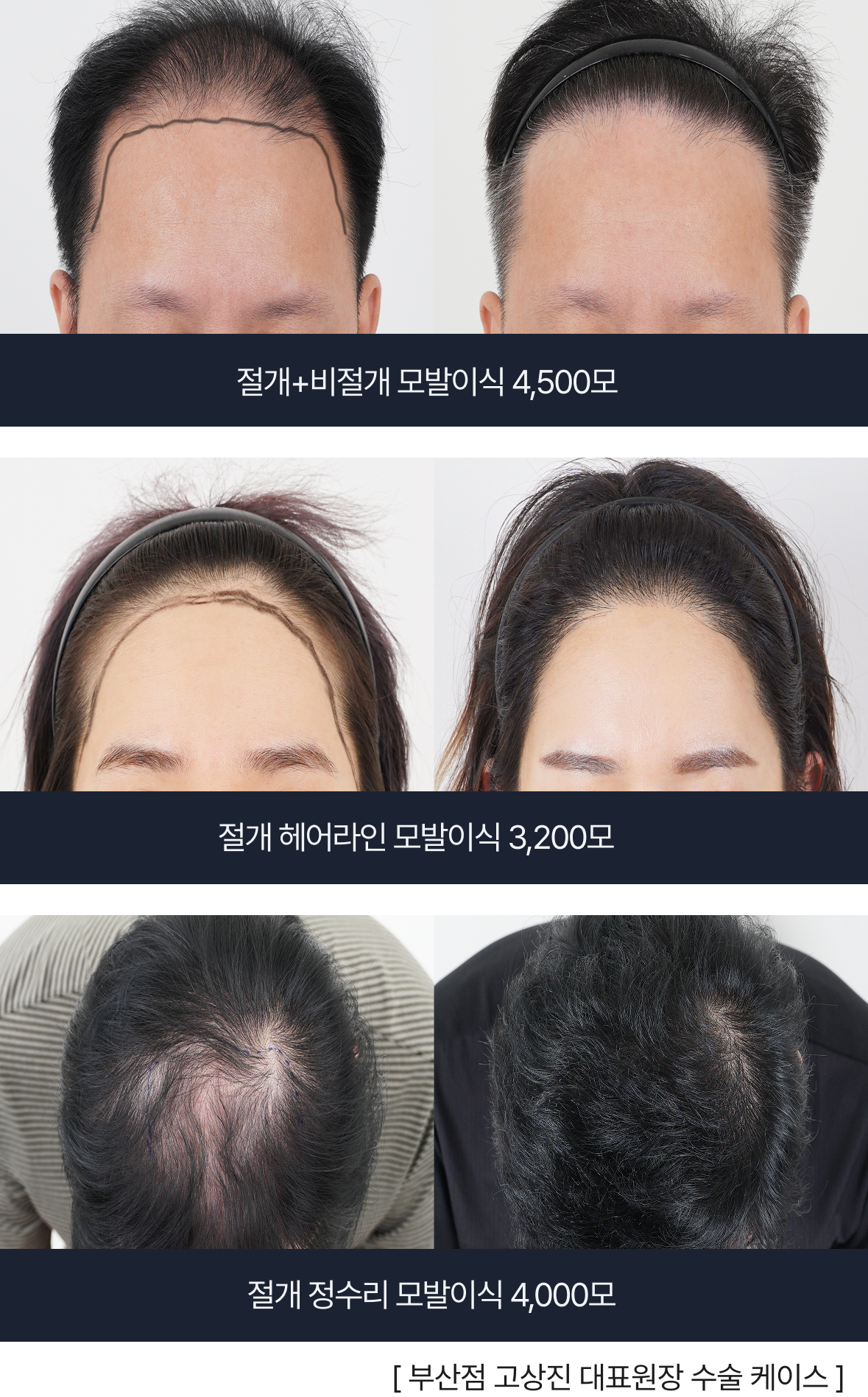 고상진 대표원장 모발이식 스토리