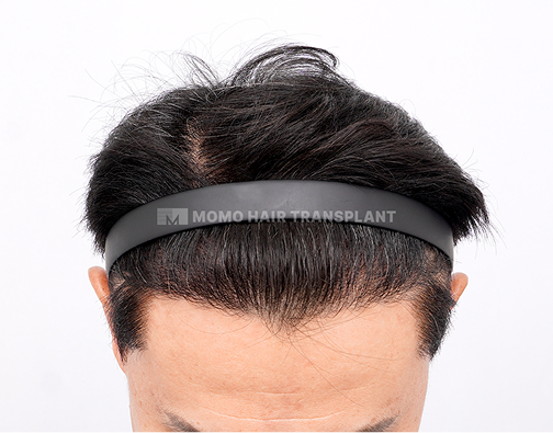 남성 절개 모발이식 after