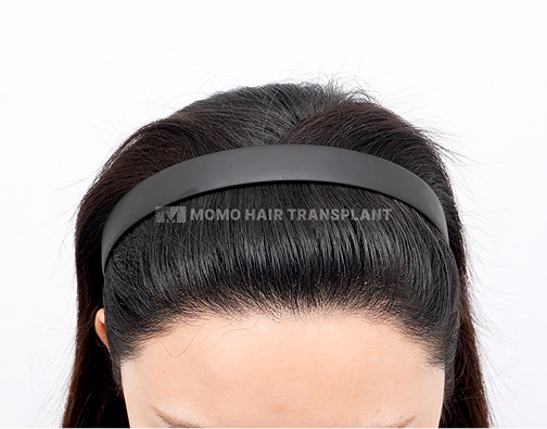 여성 절개 모발이식 after