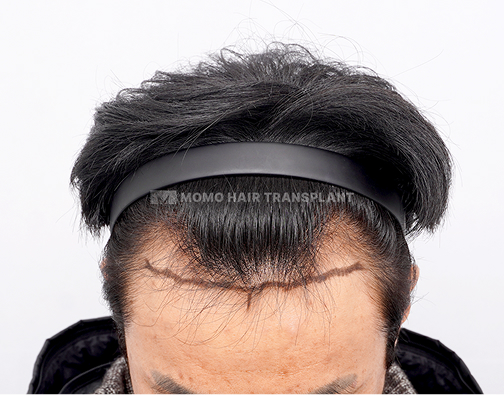 남성 절개 모발이식 before
