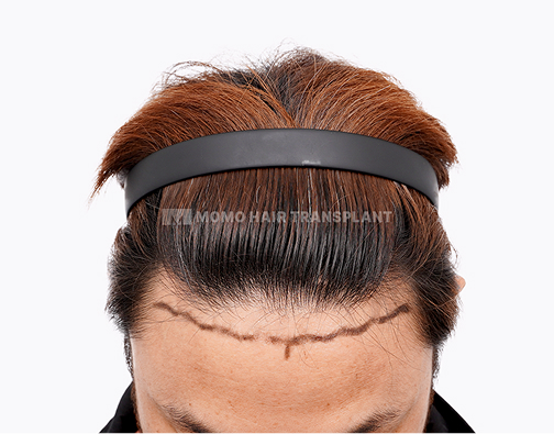 남성 절개 모발이식 before