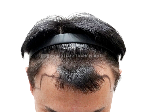 남성 절개 모발이식 before