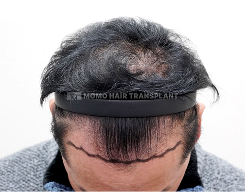 남성 절개 모발이식 before